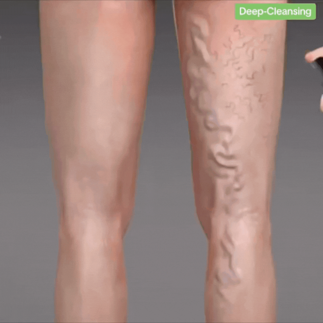 🦵 Nuevo VenaDerm Pro™ – Spray Terapéutico para Várices