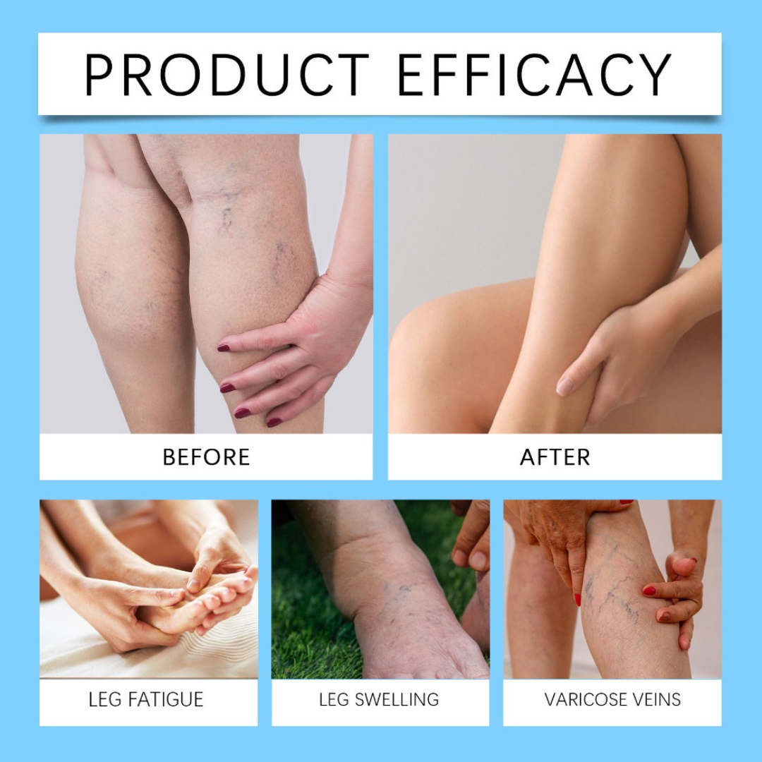🦵 Nuevo VenaDerm Pro™ – Spray Terapéutico para Várices
