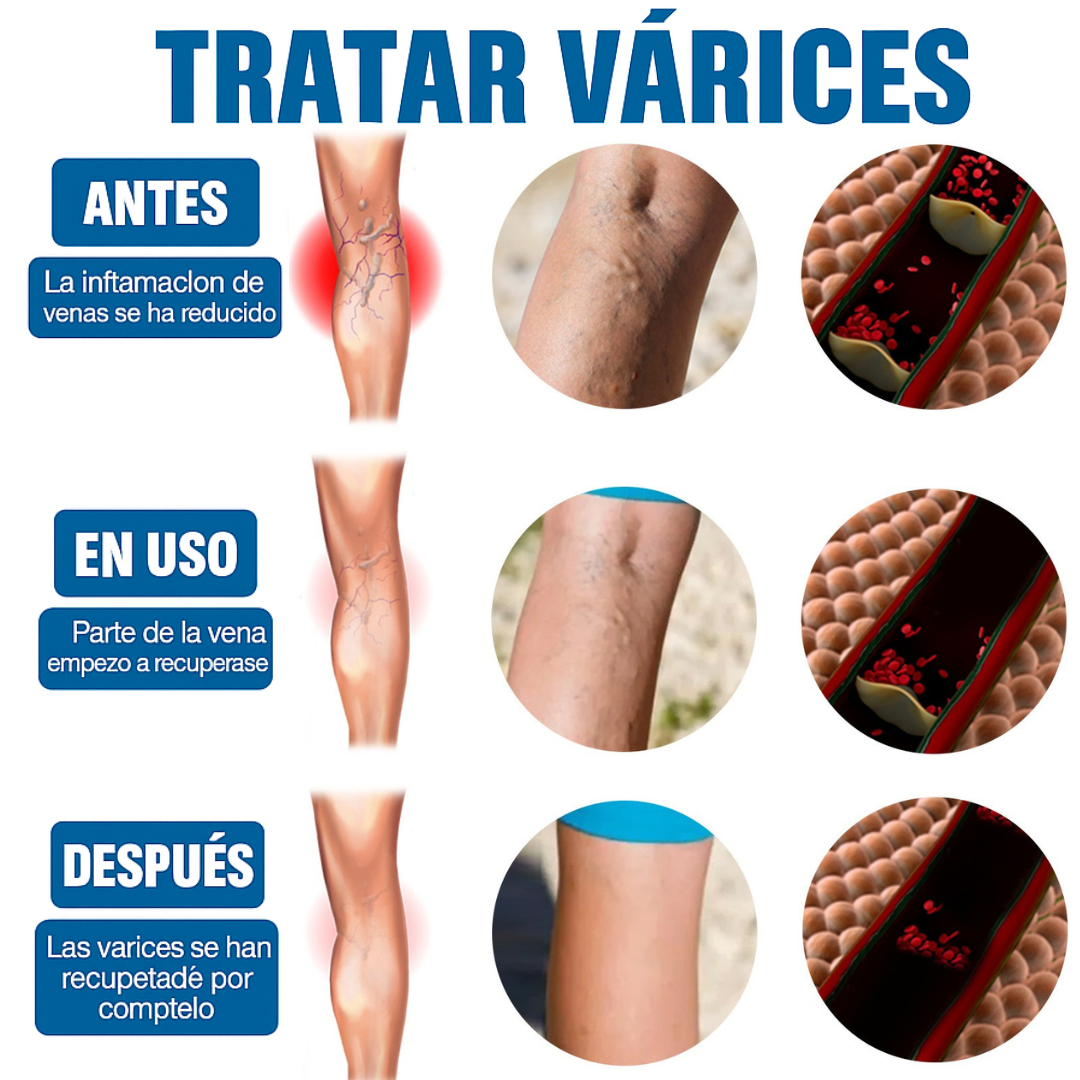 🦵 Nuevo VenaDerm Pro™ – Spray Terapéutico para Várices