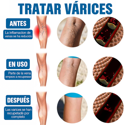 🦵 Nuevo VenaDerm Pro™ – Spray Terapéutico para Várices